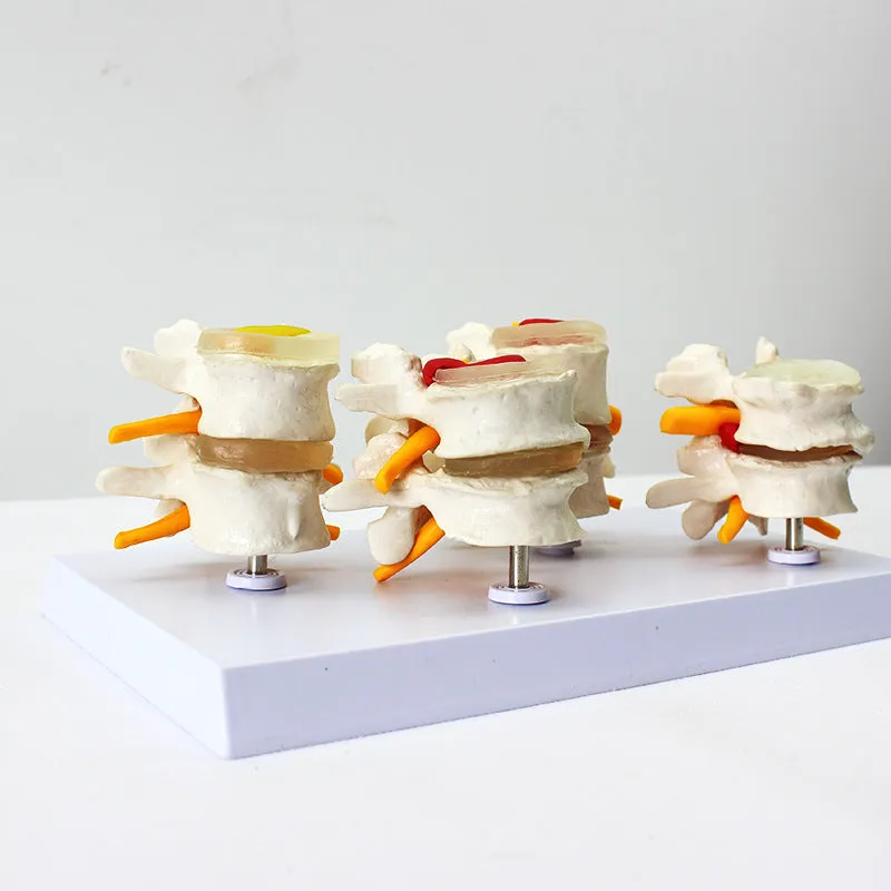 Human Anatomy Skeleton Spine 4-Stages Lumbar Vertebral Model Brain Skull Traumatic Medical Teaching Supplies