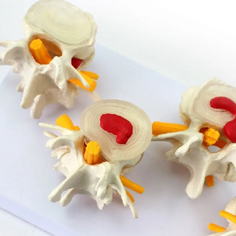 Human Anatomy Skeleton Spine 4-Stages Lumbar Vertebral Model Brain Skull Traumatic Medical Teaching Supplies