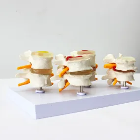 Human Anatomy Skeleton Spine 4-Stages Lumbar Vertebral Model Brain Skull Traumatic Medical Teaching Supplies